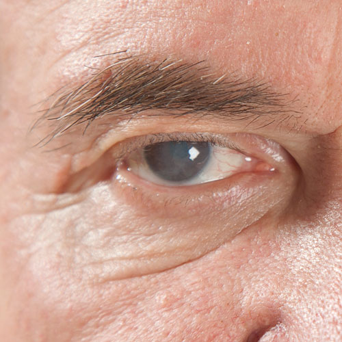 A man's eye clouded by glaucoma
